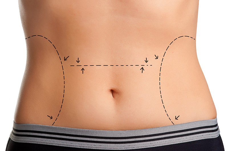 Tummy Tuck Weston - Abdominoplasty Weston