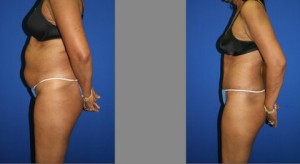 Abdominoplasty and Liposuction of Hips