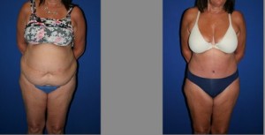 Tummy Tuck before and after, Abdominoplasty
