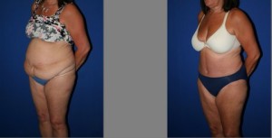 Tummy Tuck before and after, Abdominoplasty