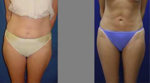 Liposuction - Abdomen and Thighs