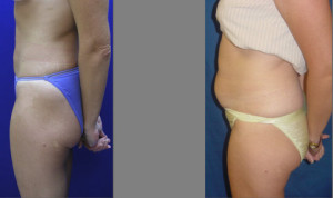 Liposuction - Abdomen and Thighs
