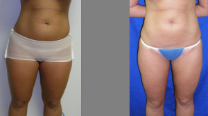 Liposuction - Abdomen and Thighs