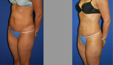 Abdominoplasty, Tummy Tuck Before and After