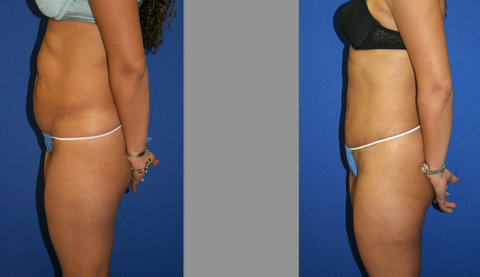 Abdominoplasty, Tummy Tuck Before and After