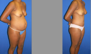 Abdominoplasty, Liposuction, Tummy Tuck Before and After