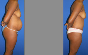 Abdominoplasty, Liposuction, Tummy Tuck Before and After