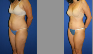Abdominoplasty, Liposuction, Tummy Tuck Before and After