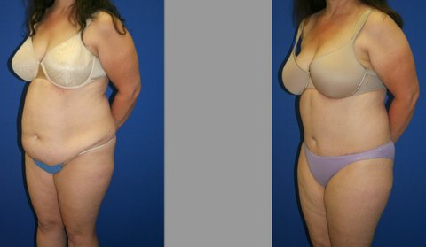Abdominoplasty and Liposuction of Hips
