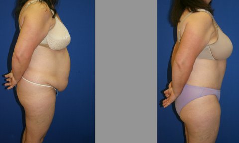 Abdominoplasty and Liposuction of Hips