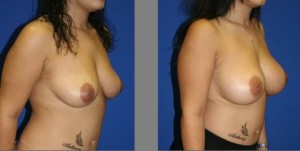 Breast Augmentation, Plastic Surgery, Breast Augmentation Before and After