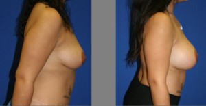 Breast Augmentation, Plastic Surgery, Breast Augmentation Before and After