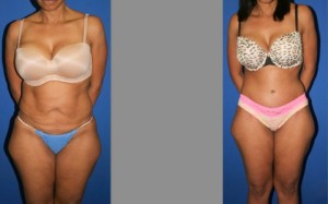 Tummy Tuck before and after, Abdominoplasty