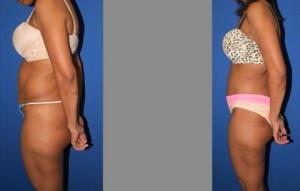 Tummy Tuck before and after, Abdominoplasty