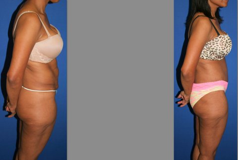 Tummy Tuck before and after, Abdominoplasty