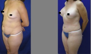 Mommy Makeover, Tummy Tuck Before and After, Breast Augmentation, Abdominoplasty and Liposuction of Hips