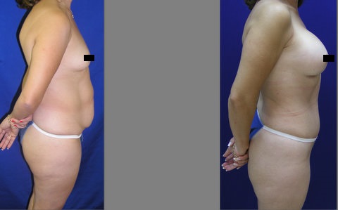 Mommy Makeover, Tummy Tuck Before and After, Breast Augmentation, Abdominoplasty and Liposuction of Hips