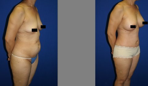 Mommy Makeover, Tummy Tuck Before and After, Breast Augmentation, Abdominoplasty and Liposuction of Hips
