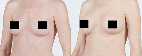 Natrelle Breast Implant